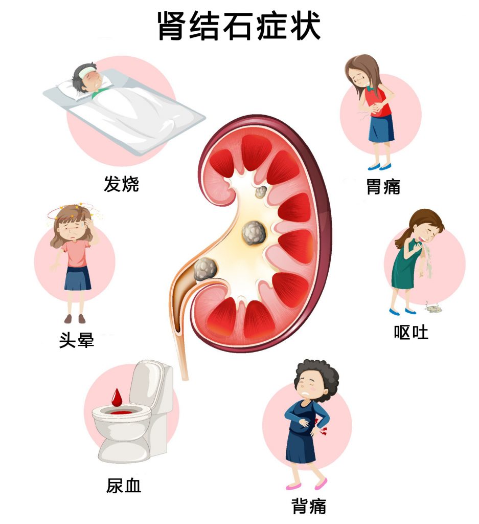 肾结石越来越多 都是喝茶惹的祸 超过一定量 研究 可能喝出肾损伤