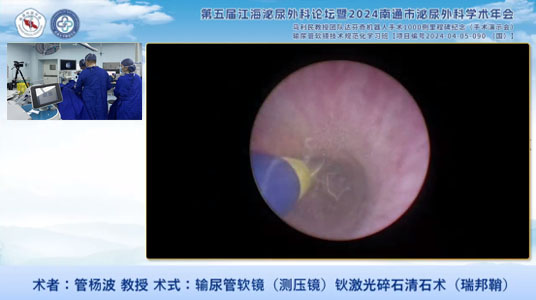 管杨波教授输尿管软镜钬激光碎石清石术