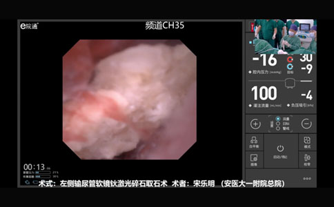 左侧输尿管软镜钬激光碎石取石术