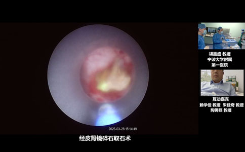 经皮肾镜碎石取石术